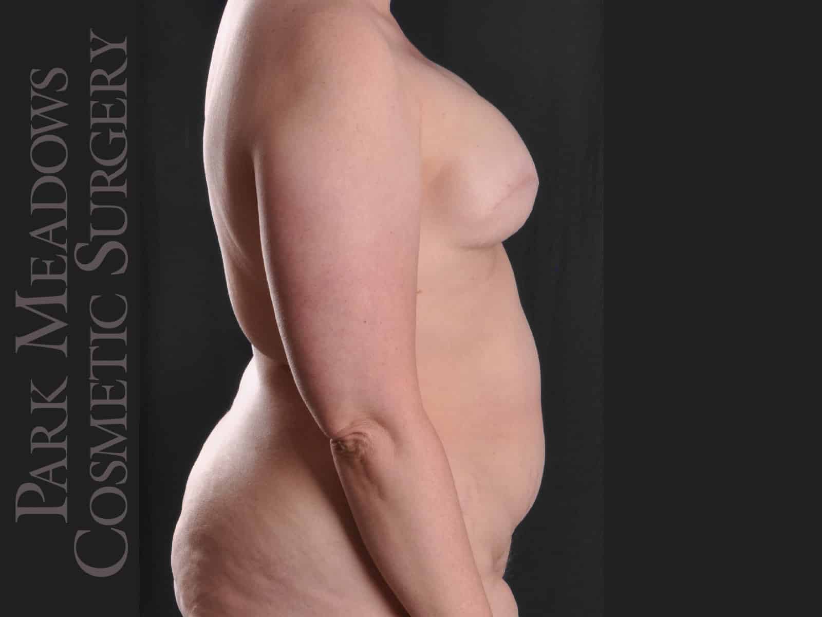 Before Image: Bilateral mastectomy with tissue expanders; DIEP Flap; three separate fat grafting sessions; nipple reconstruction and areola pigmentation - right-side