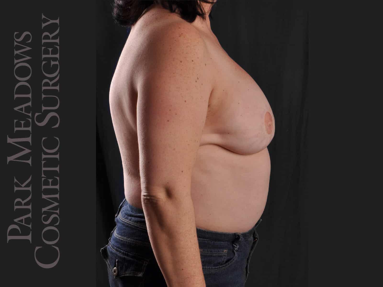 After Image: Bilateral DIEP Flap; one separate fat grafting session; nipple reconstruction and areola pigmentation - right-side