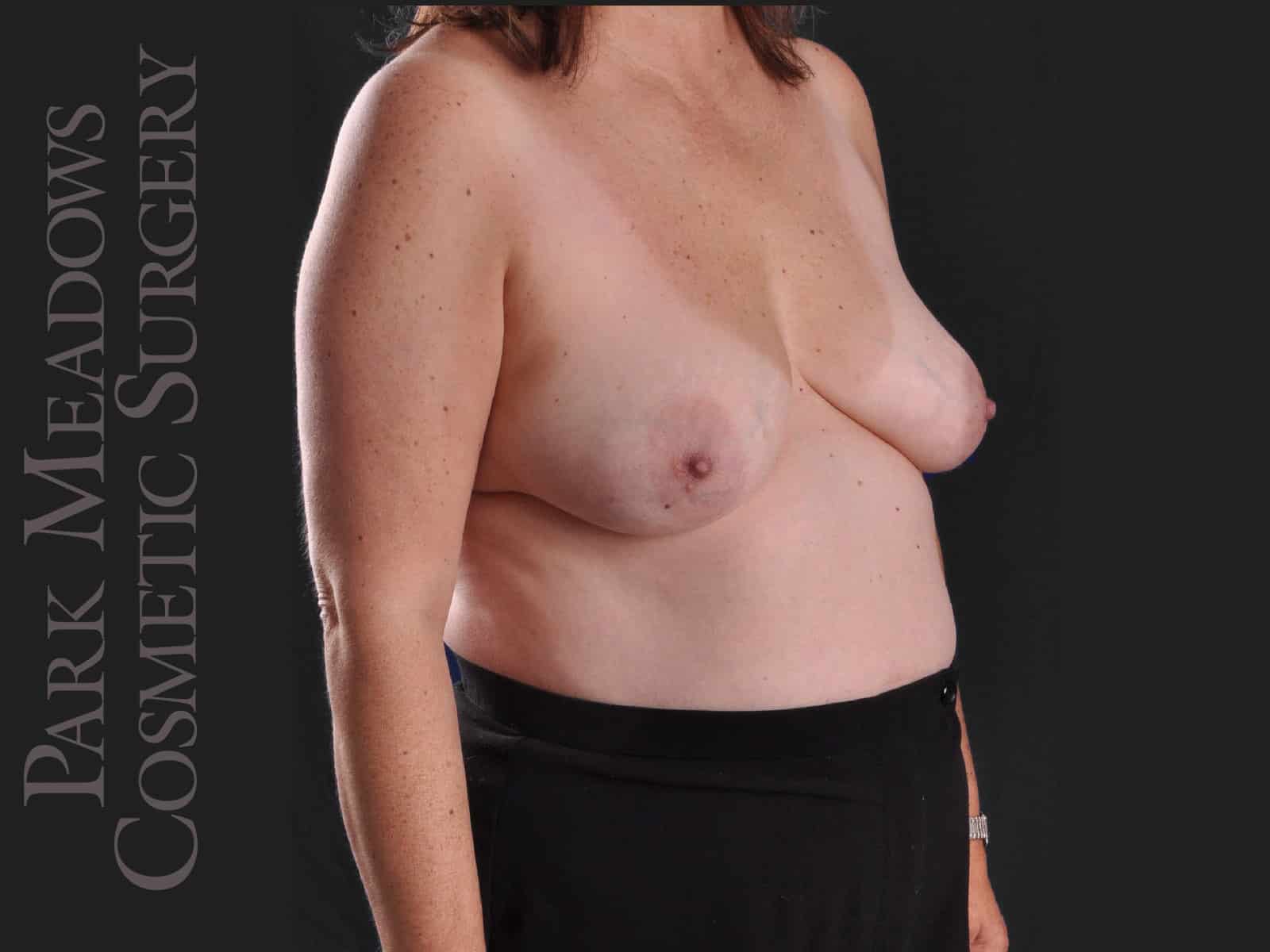 Before Image: Bilateral DIEP Flap; one separate fat grafting session; nipple reconstruction and areola pigmentation - right-front-oblique