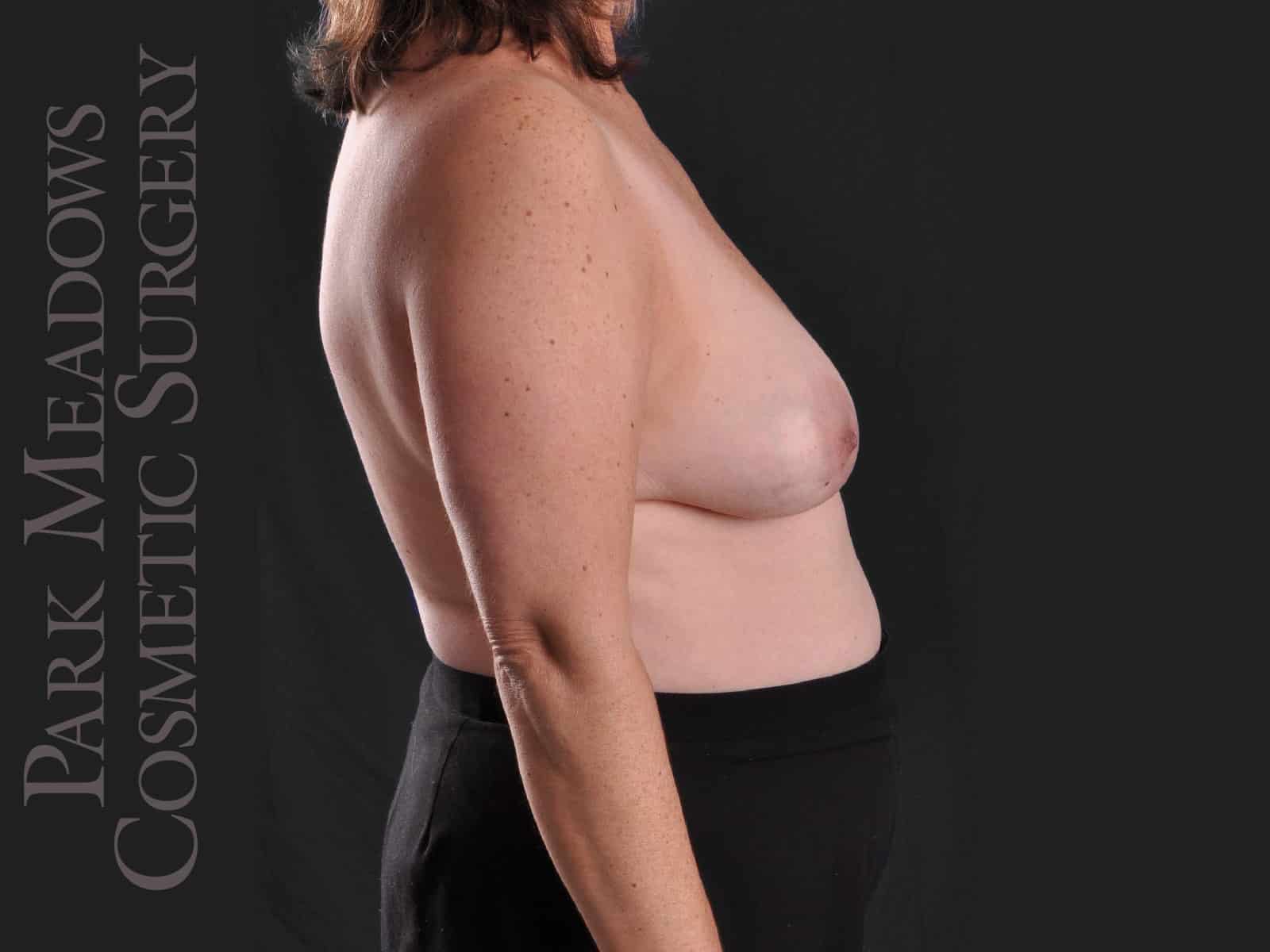 Before Image: Bilateral DIEP Flap; one separate fat grafting session; nipple reconstruction and areola pigmentation - right-side