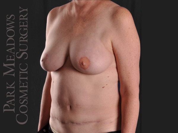 After Image: Immediate unilateral (left) DIEP Flap; two fat grafting sessions; breast reduction on right breast; nipple reconstruction; areola pigmentation - left-front-oblique
