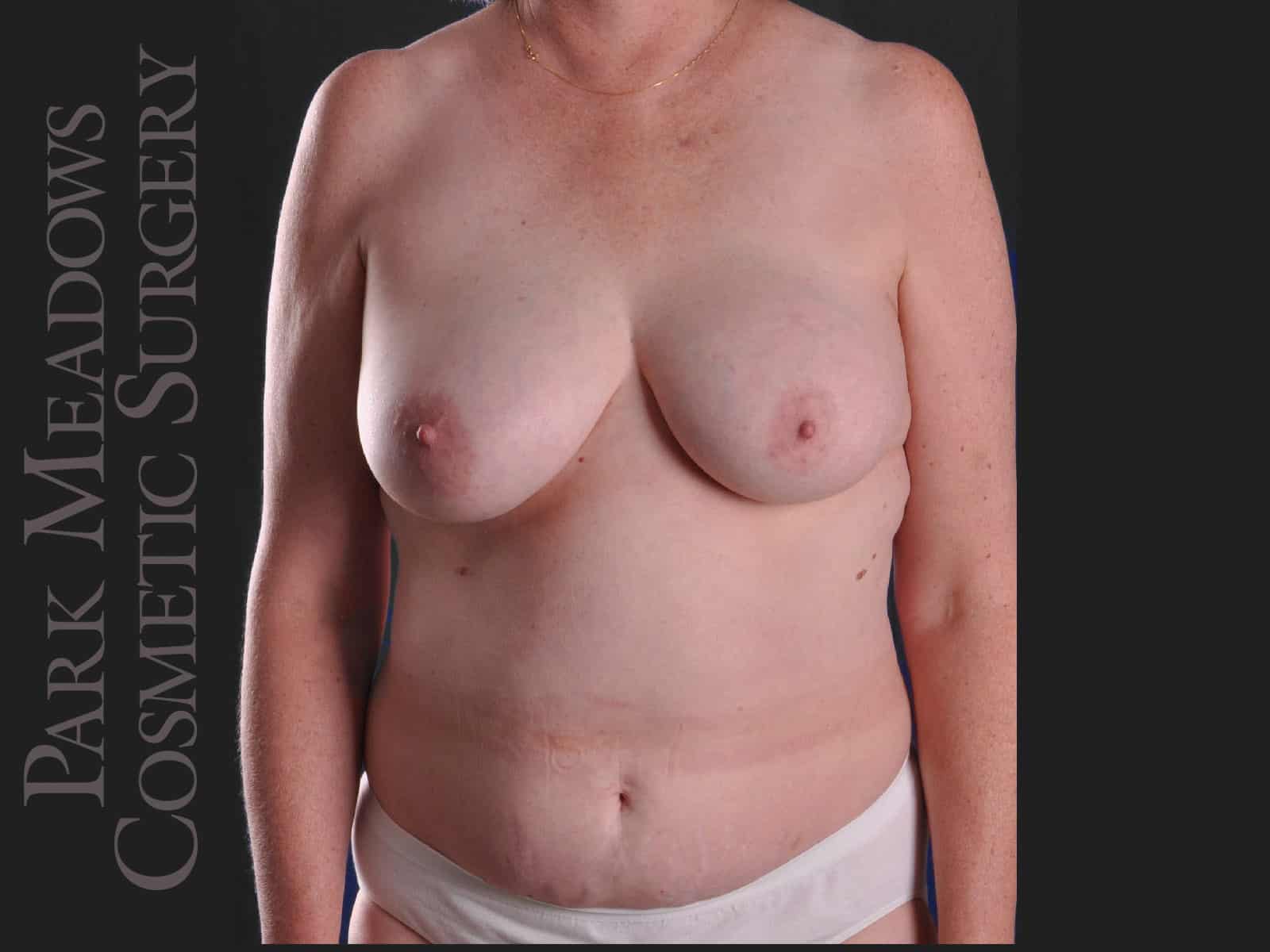 Before Image: Immediate unilateral (left) DIEP Flap; two fat grafting sessions; breast reduction on right breast; nipple reconstruction; areola pigmentation - front