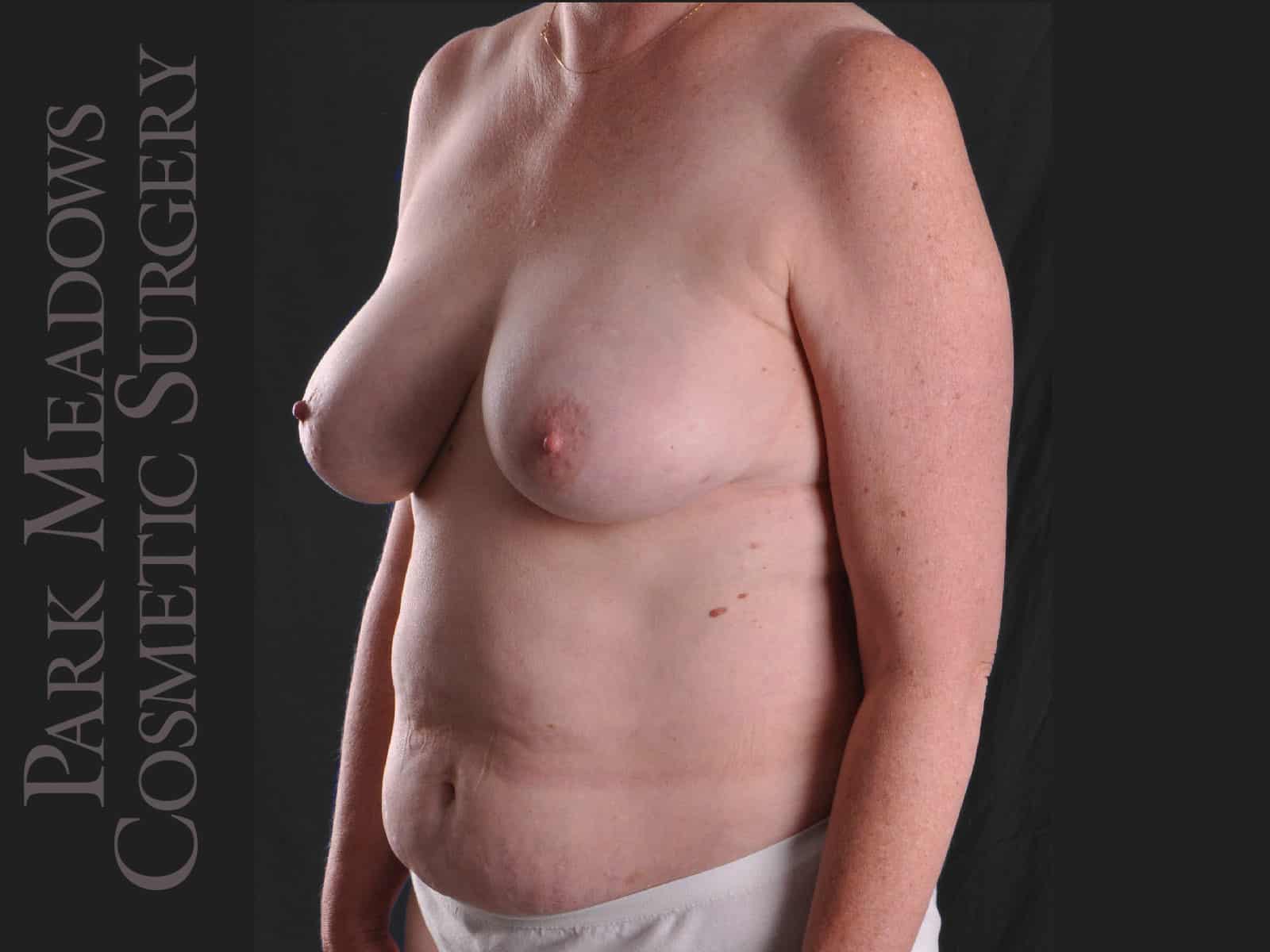 Before Image: Immediate unilateral (left) DIEP Flap; two fat grafting sessions; breast reduction on right breast; nipple reconstruction; areola pigmentation - left-front-oblique