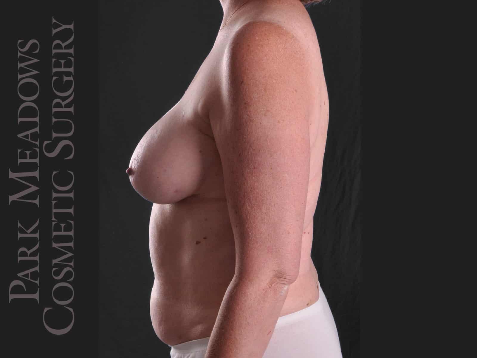 Before Image: Immediate unilateral (left) DIEP Flap; two fat grafting sessions; breast reduction on right breast; nipple reconstruction; areola pigmentation - left-side