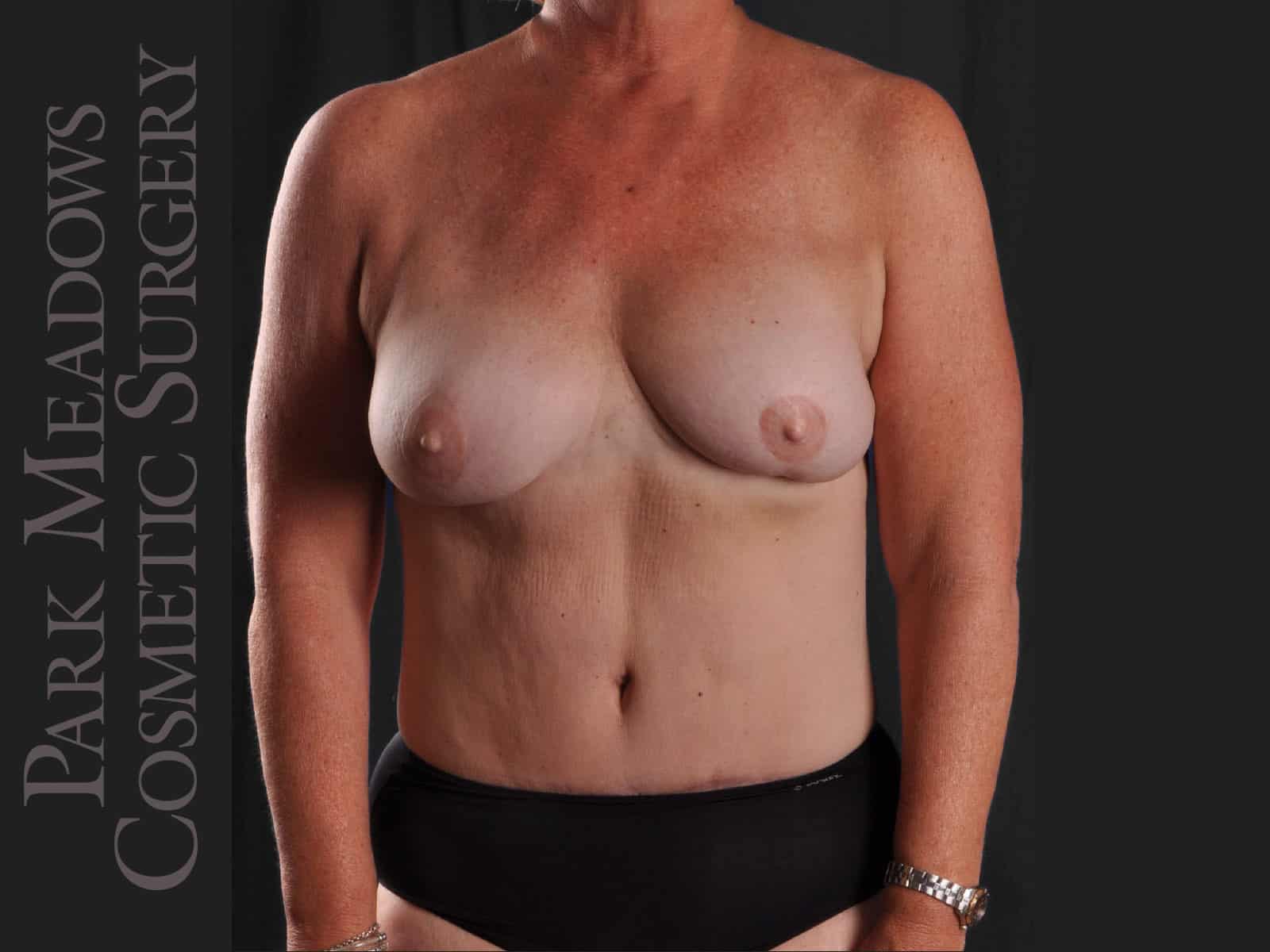 After Image: Bilateral DIEP Flap; two separate fat grafting sessions; nipple reconstruction and areola pigmentation - front