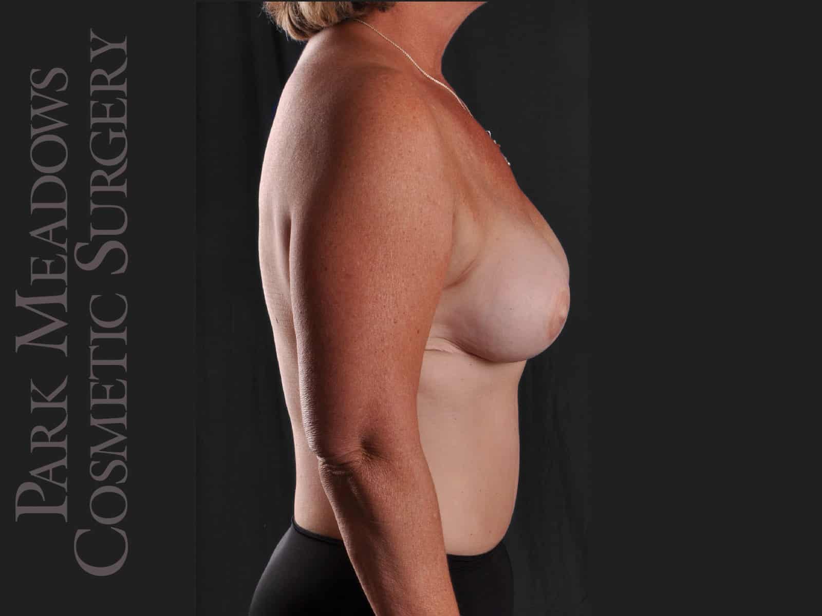 After Image: Bilateral DIEP Flap; two separate fat grafting sessions; nipple reconstruction and areola pigmentation - right-side