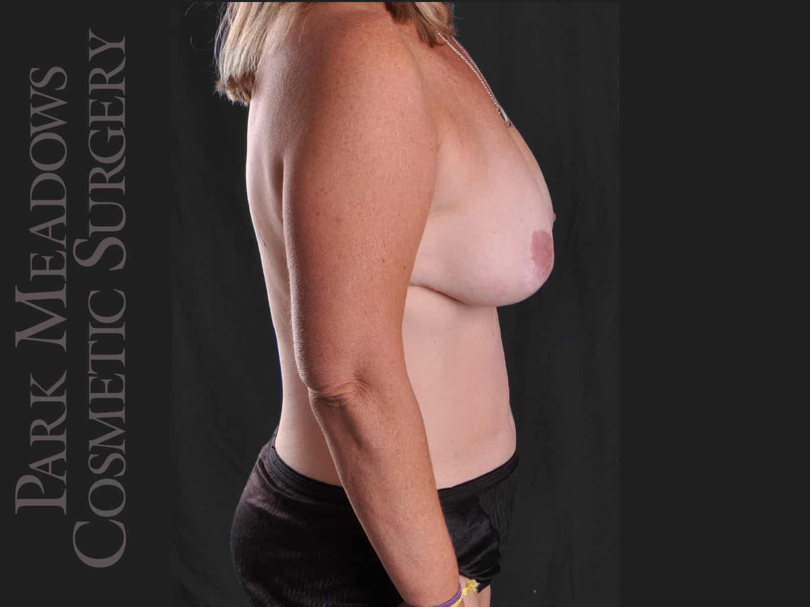 Before Image: Bilateral DIEP Flap; two separate fat grafting sessions; nipple reconstruction and areola pigmentation - right-side