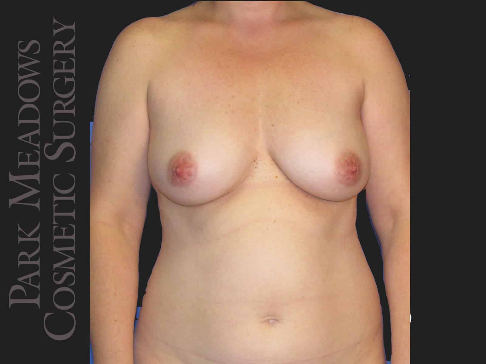 Before Image: Bilateral DIEP Flap; two separate fat grafting sessions; nipple reconstruction and areola pigmentation - front