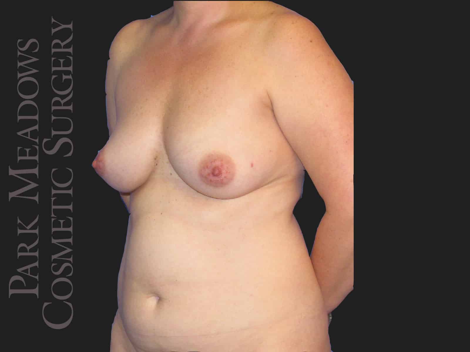 Before Image: Bilateral DIEP Flap; two separate fat grafting sessions; nipple reconstruction and areola pigmentation - left-front-oblique