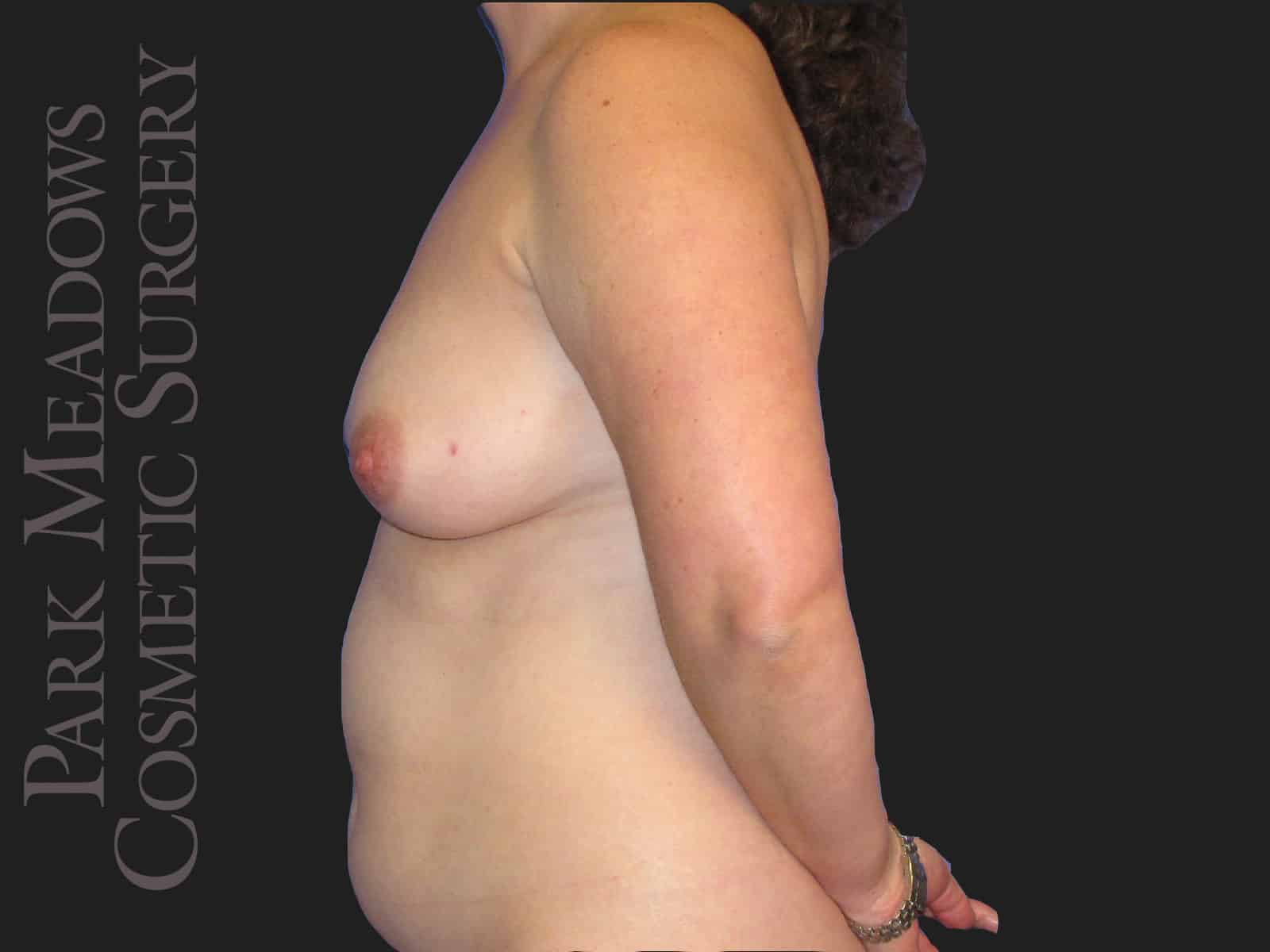 Before Image: Bilateral DIEP Flap; two separate fat grafting sessions; nipple reconstruction and areola pigmentation - left-side
