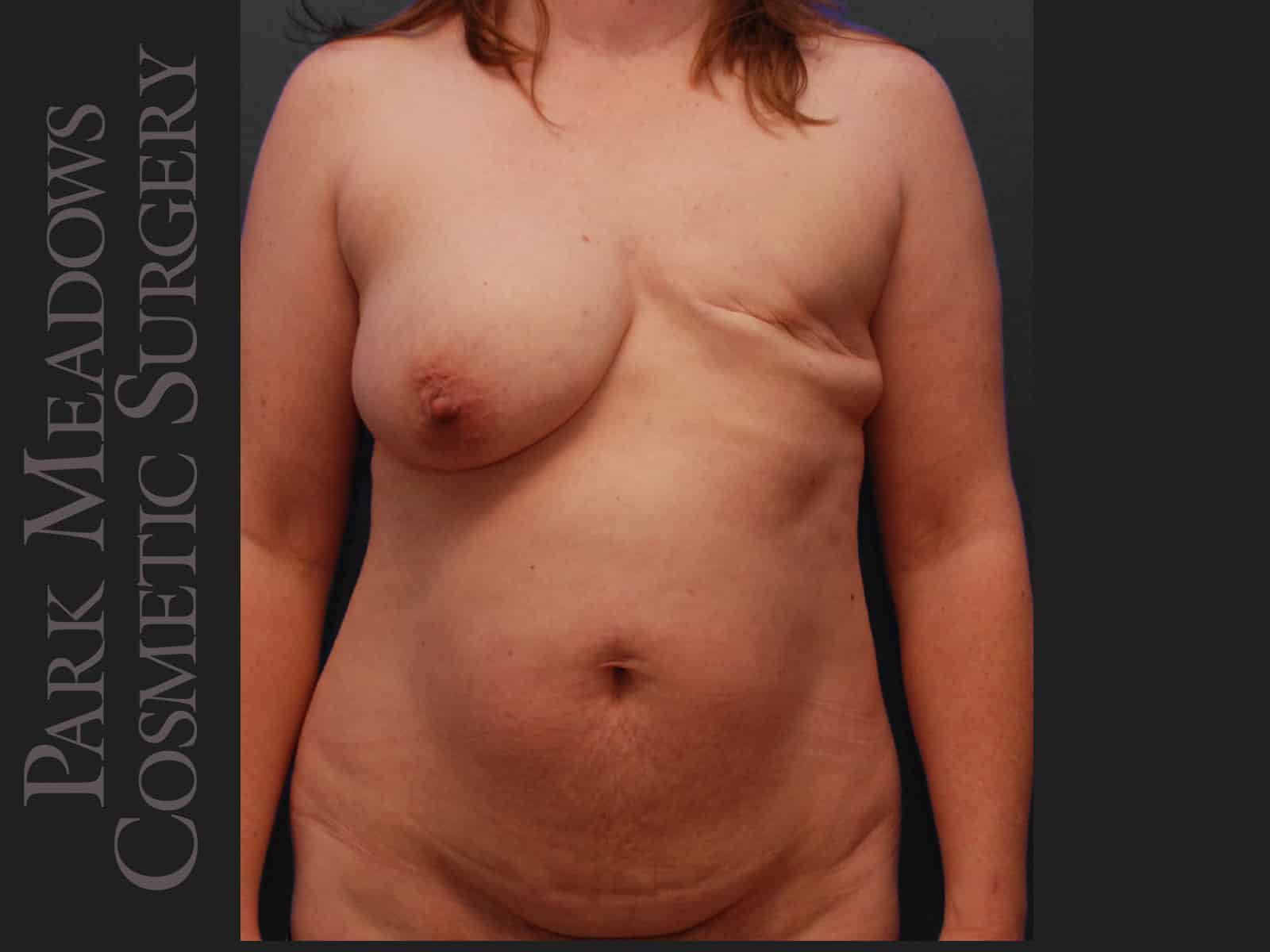 Before Image: Delayed unilateral (left) DIEP Flap; two fat grafting sessions; breast reduction on right breast; nipple reconstruction; areola pigmentation - front