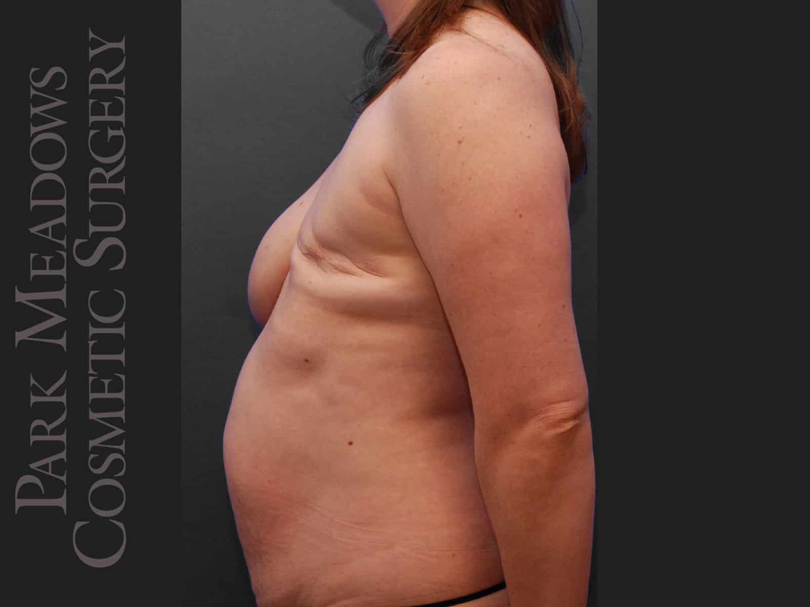 Before Image: Delayed unilateral (left) DIEP Flap; two fat grafting sessions; breast reduction on right breast; nipple reconstruction; areola pigmentation - left-side