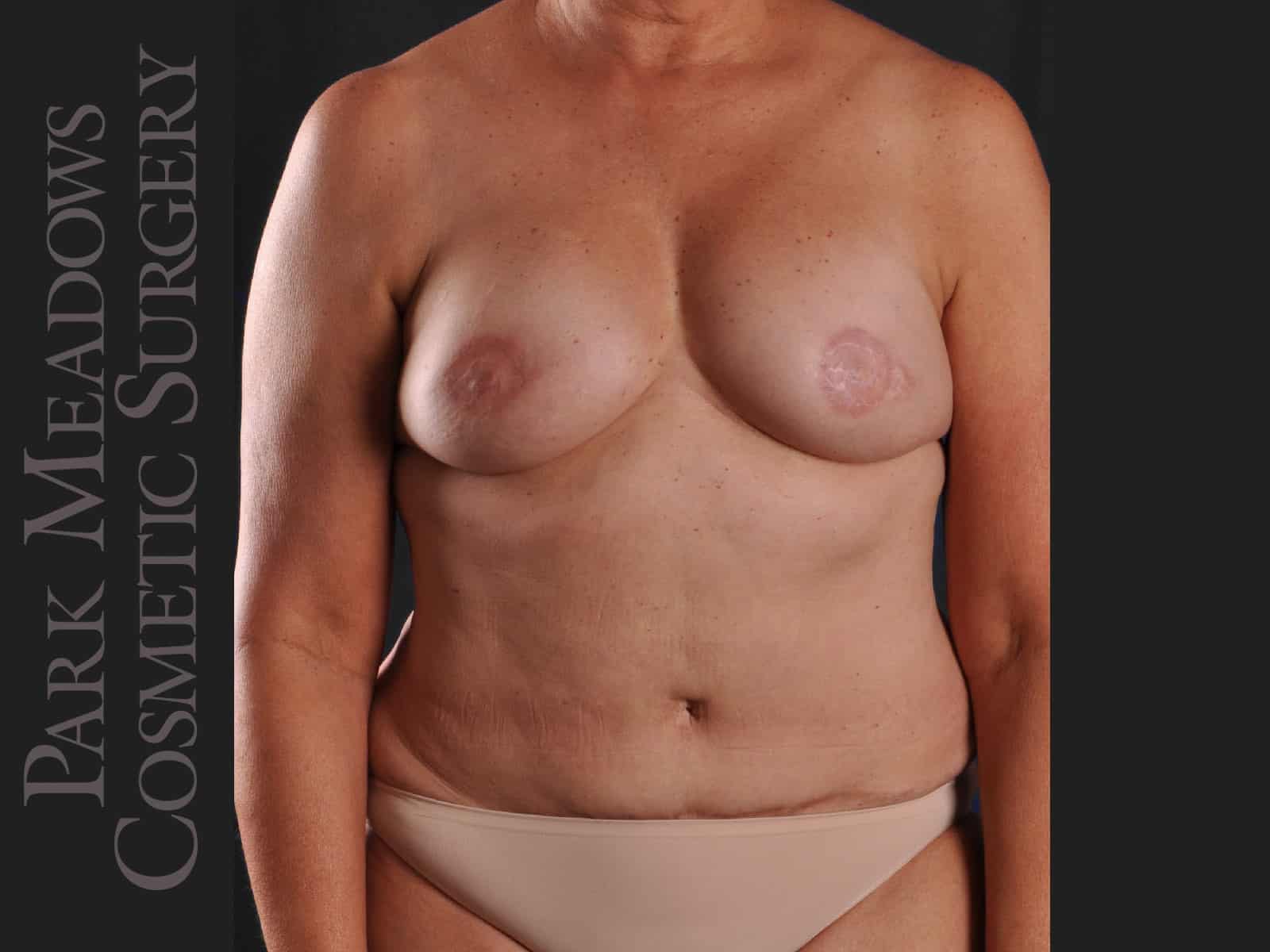 Bilateral DIEP Flap; two separate fat grafting sessions; nipple reconstruction and areola pigmentation