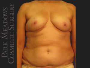 Bilateral DIEP Flap; two separate fat grafting sessions; nipple reconstruction and areola pigmentation