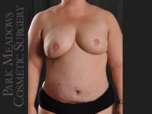 Bilateral DIEP Flap; three separate fat grafting sessions; nipple reconstruction and areola pigmentation