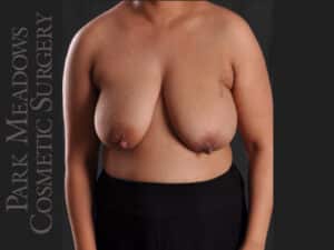 Bilateral mastectomy with tissue expanders; DIEP Flap; two separate fat grafting sessions; nipple reconstruction and areola pigmentation