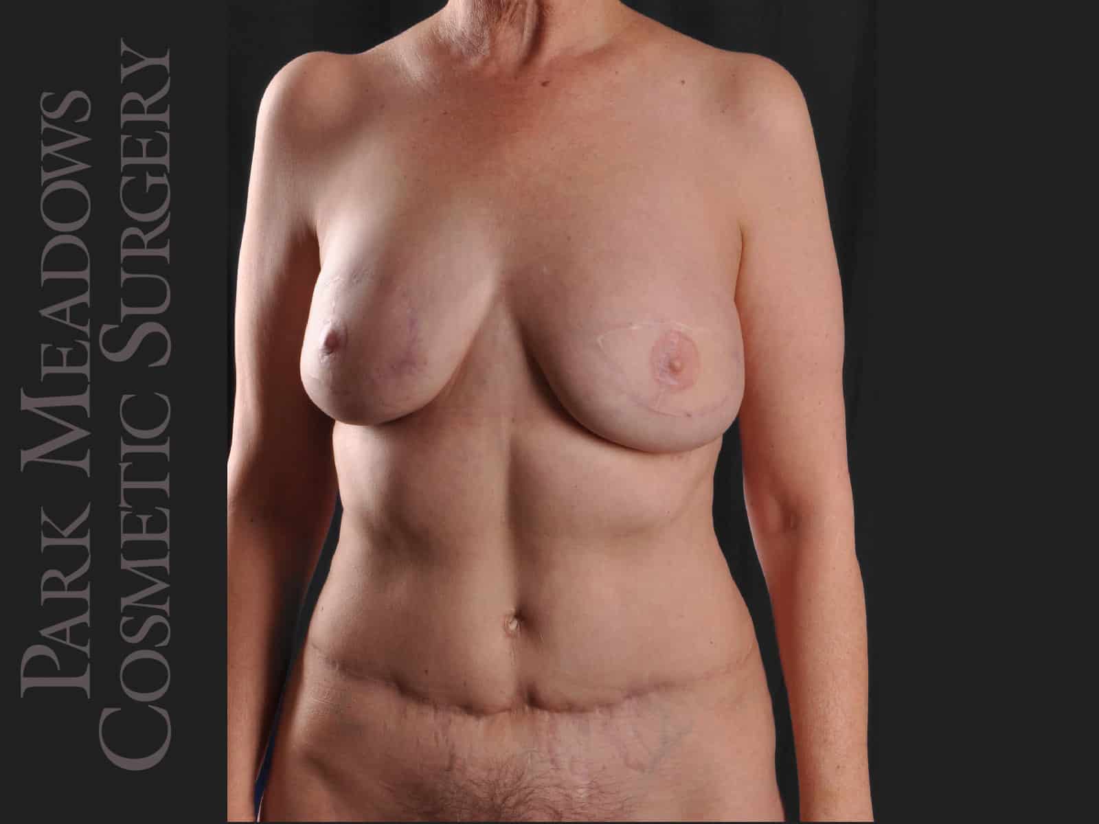 After Image: Delayed bilateral DIEP Flap; one fat grafting session with nipple reconstruction; areola pigmentation - front