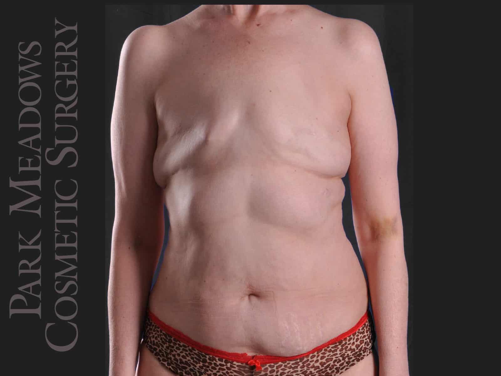 Before Image: Delayed bilateral DIEP Flap; one fat grafting session with nipple reconstruction; areola pigmentation - front