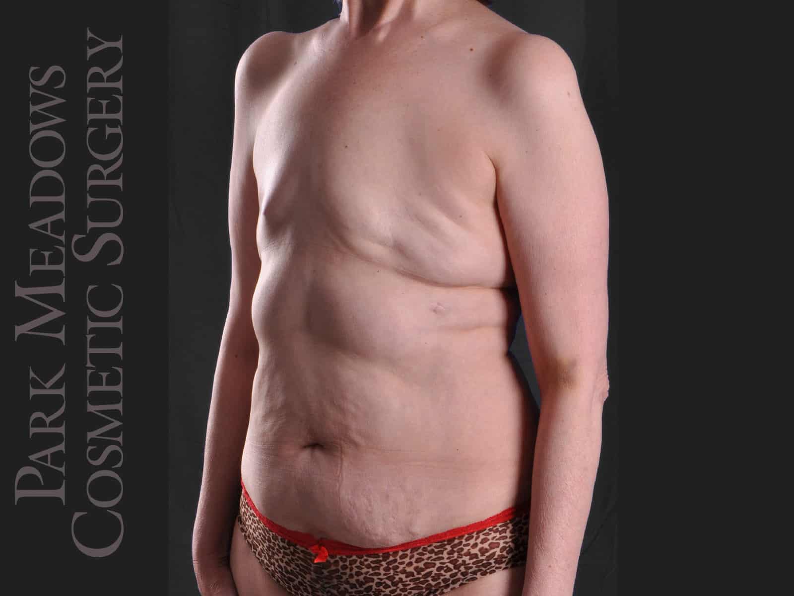 Before Image: Delayed bilateral DIEP Flap; one fat grafting session with nipple reconstruction; areola pigmentation - left-front-oblique