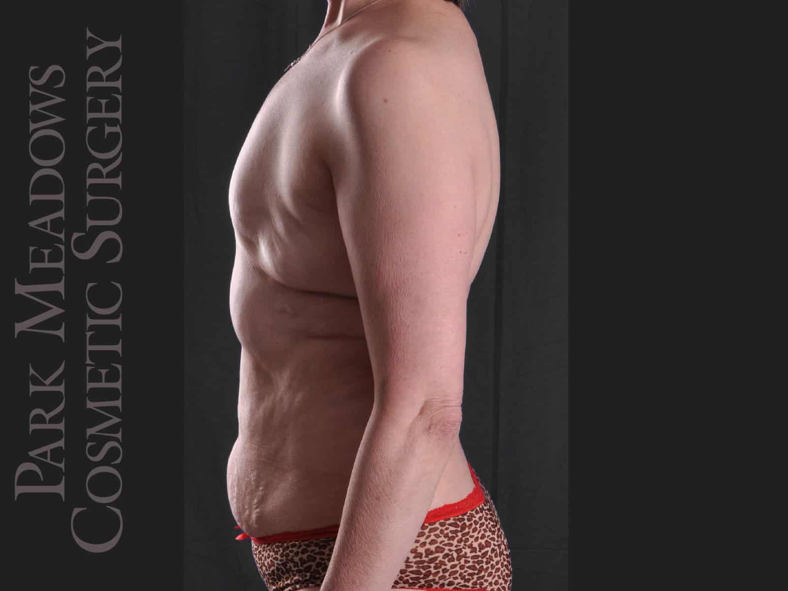 Before Image: Delayed bilateral DIEP Flap; one fat grafting session with nipple reconstruction; areola pigmentation - left-side