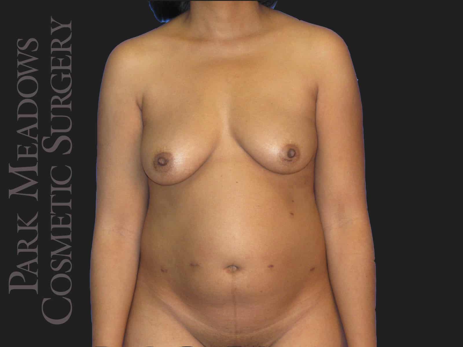 Before Image: Bilateral DIEP Flap; four separate fat grafting sessions; nipple reconstruction and areola pigmentation - front