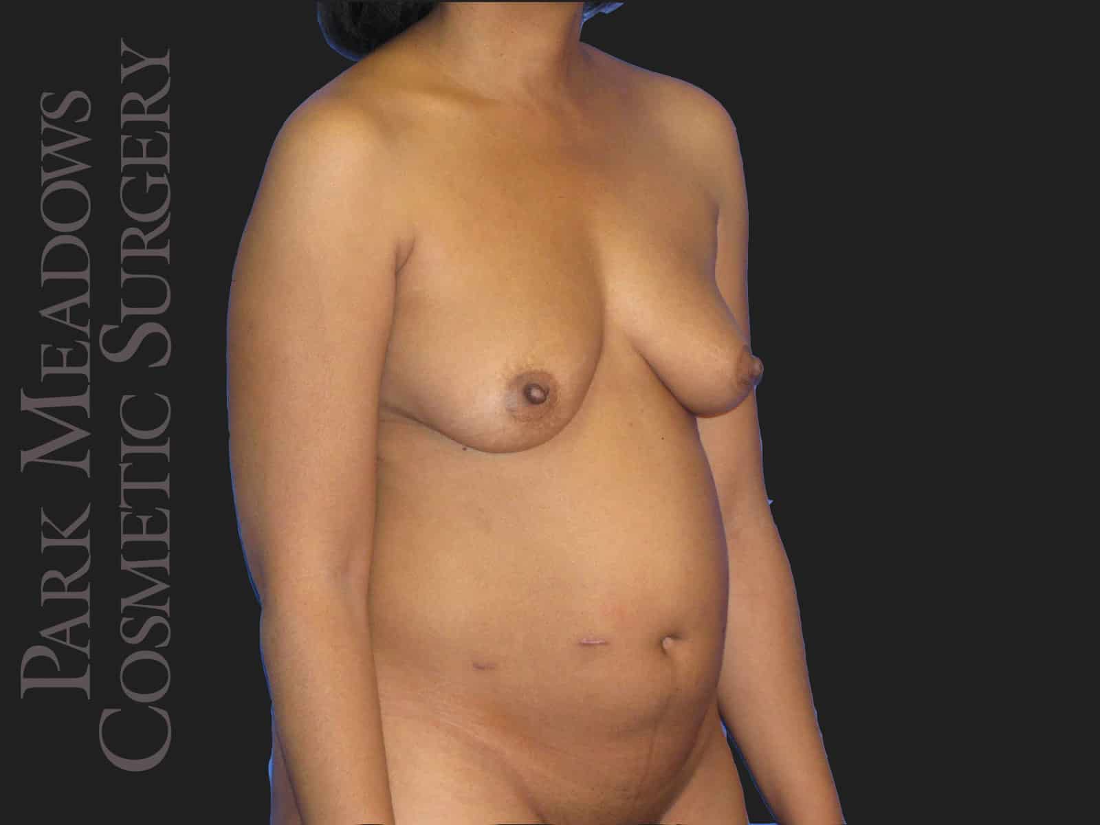 Before Image: Bilateral DIEP Flap; four separate fat grafting sessions; nipple reconstruction and areola pigmentation - right-front-oblique