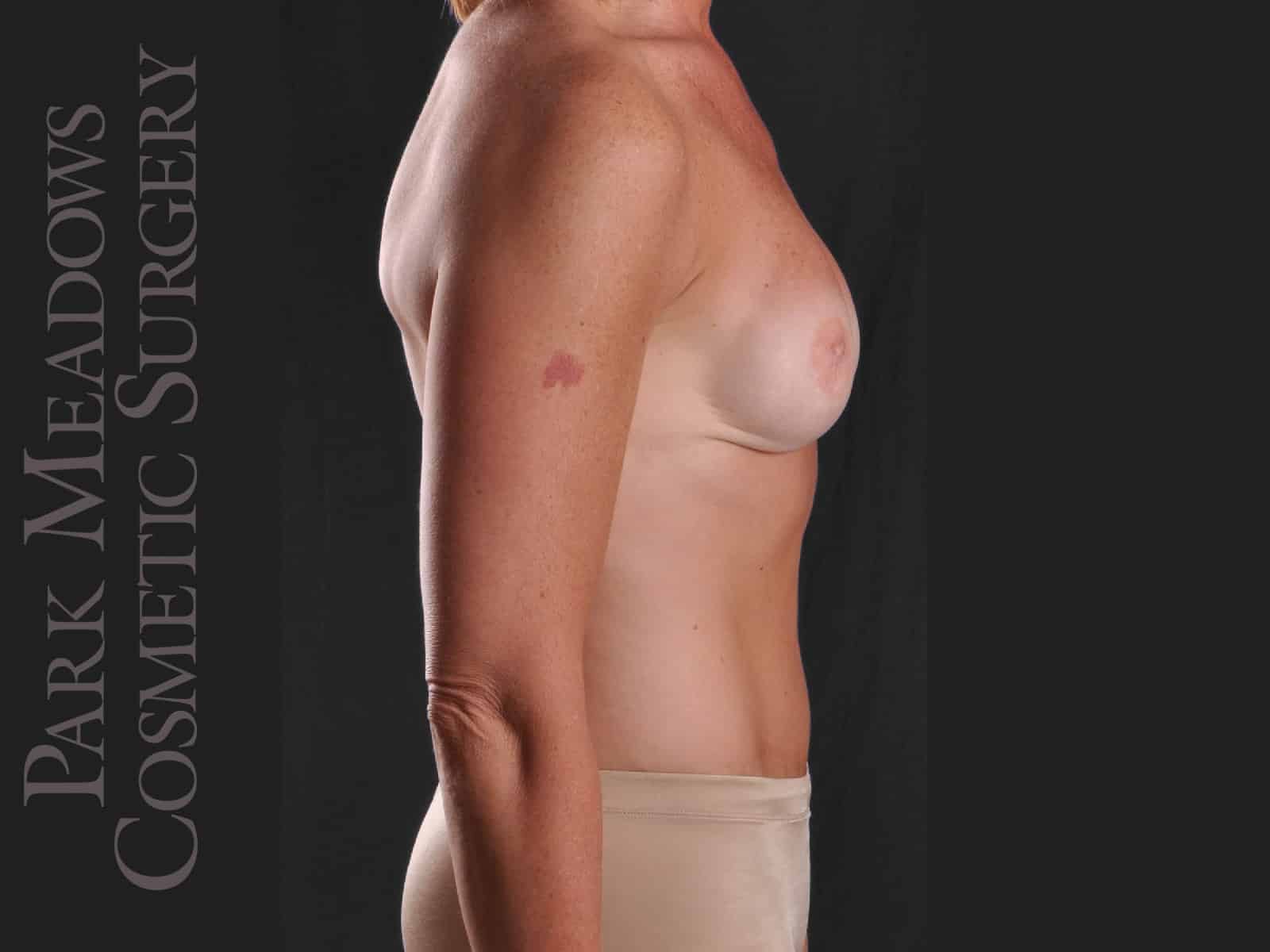 After Image: Bilateral DIEP Flap; three separate fat grafting sessions; nipple reconstruction and areola pigmentation - right-side