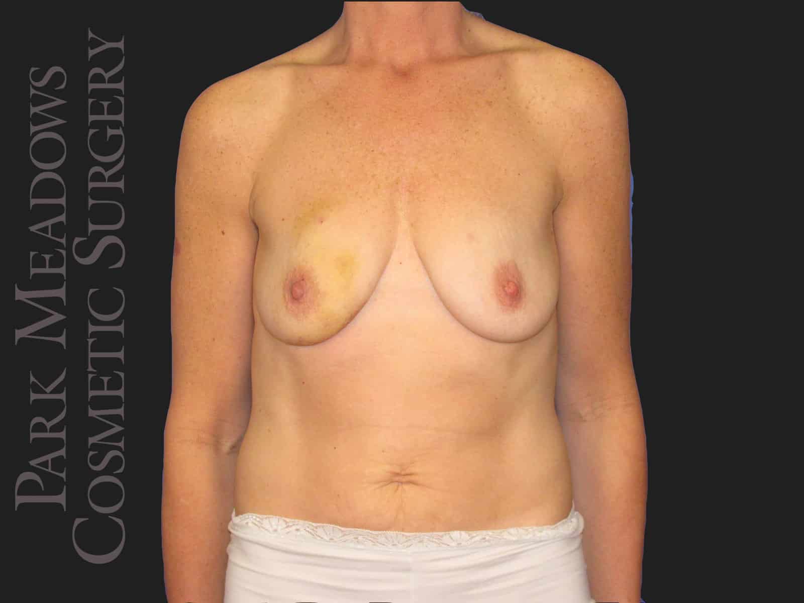 Before Image: Bilateral DIEP Flap; three separate fat grafting sessions; nipple reconstruction and areola pigmentation - front