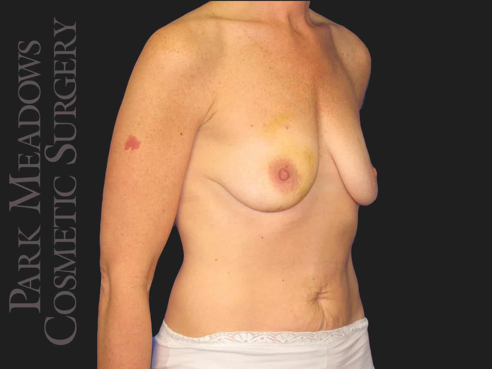 Before Image: Bilateral DIEP Flap; three separate fat grafting sessions; nipple reconstruction and areola pigmentation - right-front-oblique