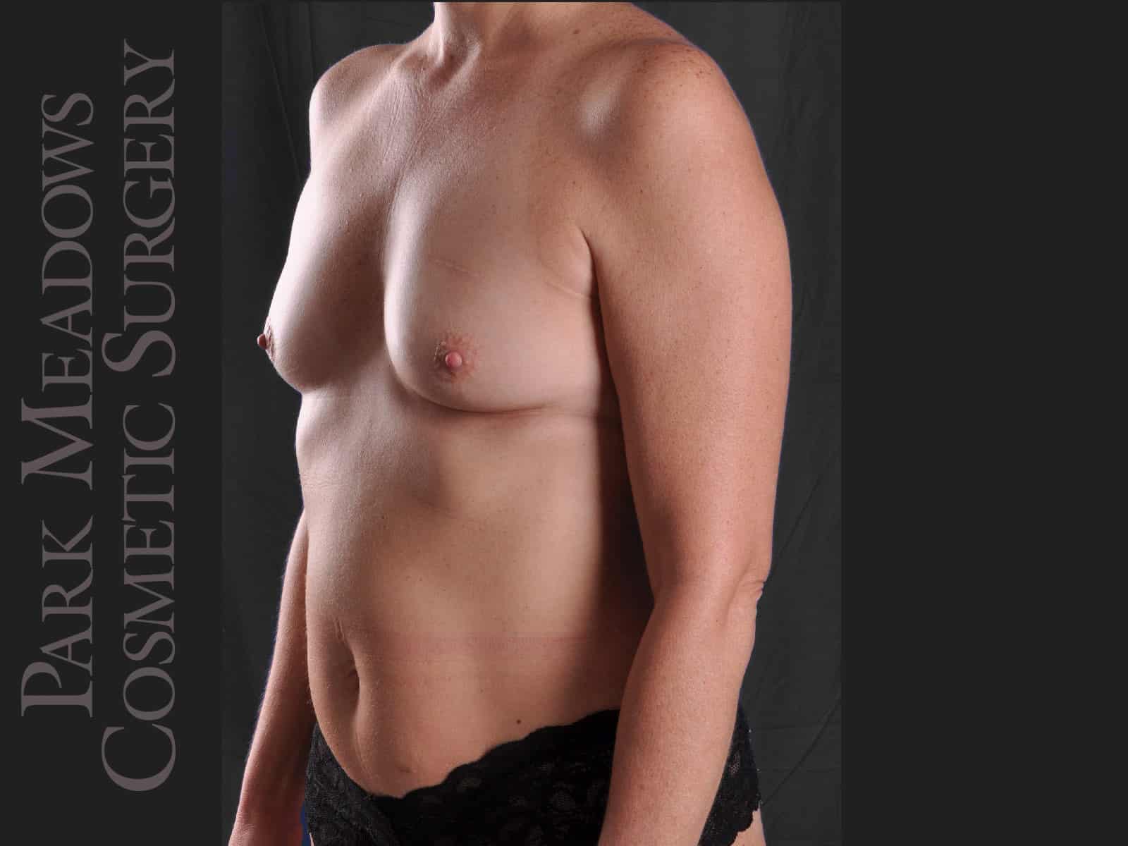 Before Image: Bilateral nipple-sparing mastectomies with DIEP Flap; two separate fat grafting sessions - left-front-oblique