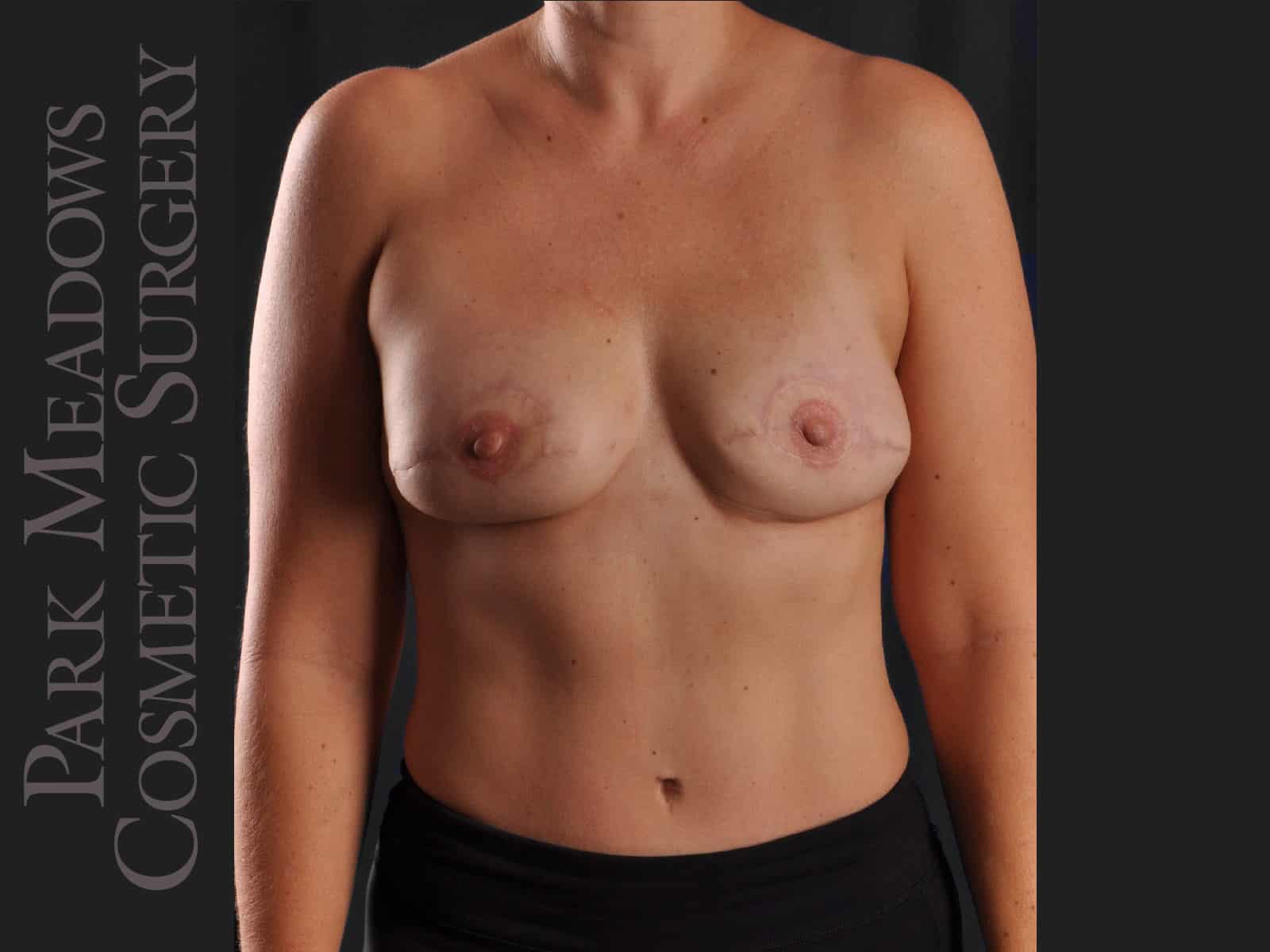 After Image: Bilateral DIEP Flap; three separate fat grafting sessions; nipple reconstruction and areola pigmentation - front