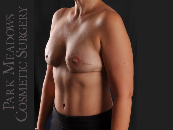 After Image: Bilateral DIEP Flap; three separate fat grafting sessions; nipple reconstruction and areola pigmentation - left-front-oblique