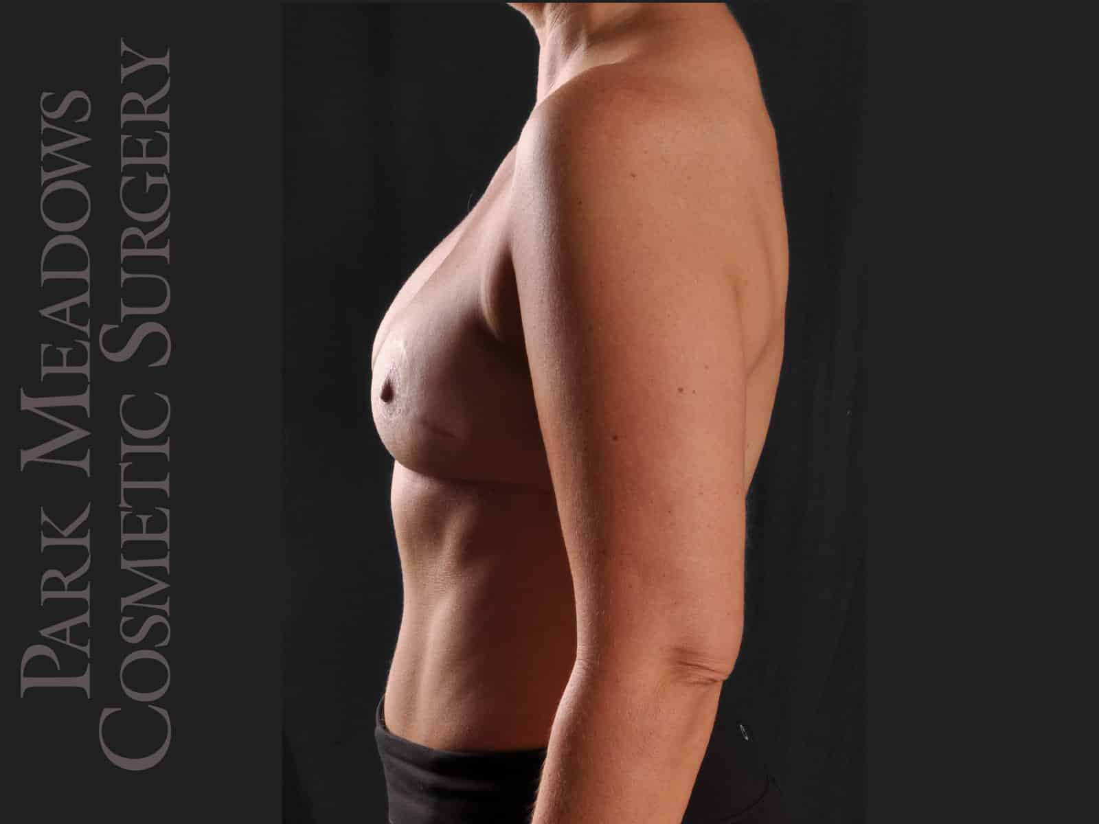 After Image: Bilateral DIEP Flap; three separate fat grafting sessions; nipple reconstruction and areola pigmentation - left-side