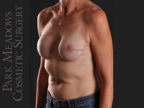 After Image: Bilateral mastectomy with tissue expanders; silicone implant exchange; nipple reconstruction and areola pigmentation - left-front-oblique