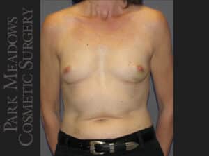Bilateral mastectomy with tissue expanders; silicone implant exchange; nipple reconstruction and areola pigmentation