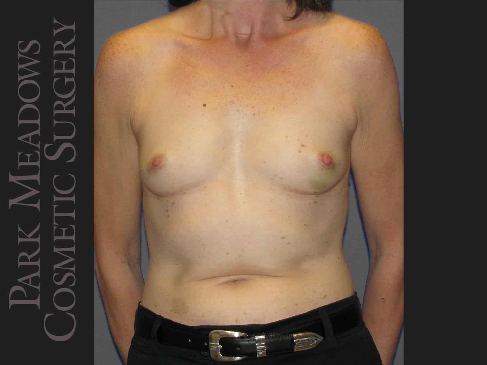 Before Image: Bilateral mastectomy with tissue expanders; silicone implant exchange; nipple reconstruction and areola pigmentation - front