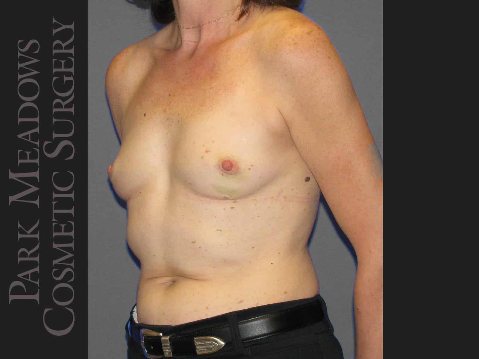 Before Image: Bilateral mastectomy with tissue expanders; silicone implant exchange; nipple reconstruction and areola pigmentation - left-front-oblique