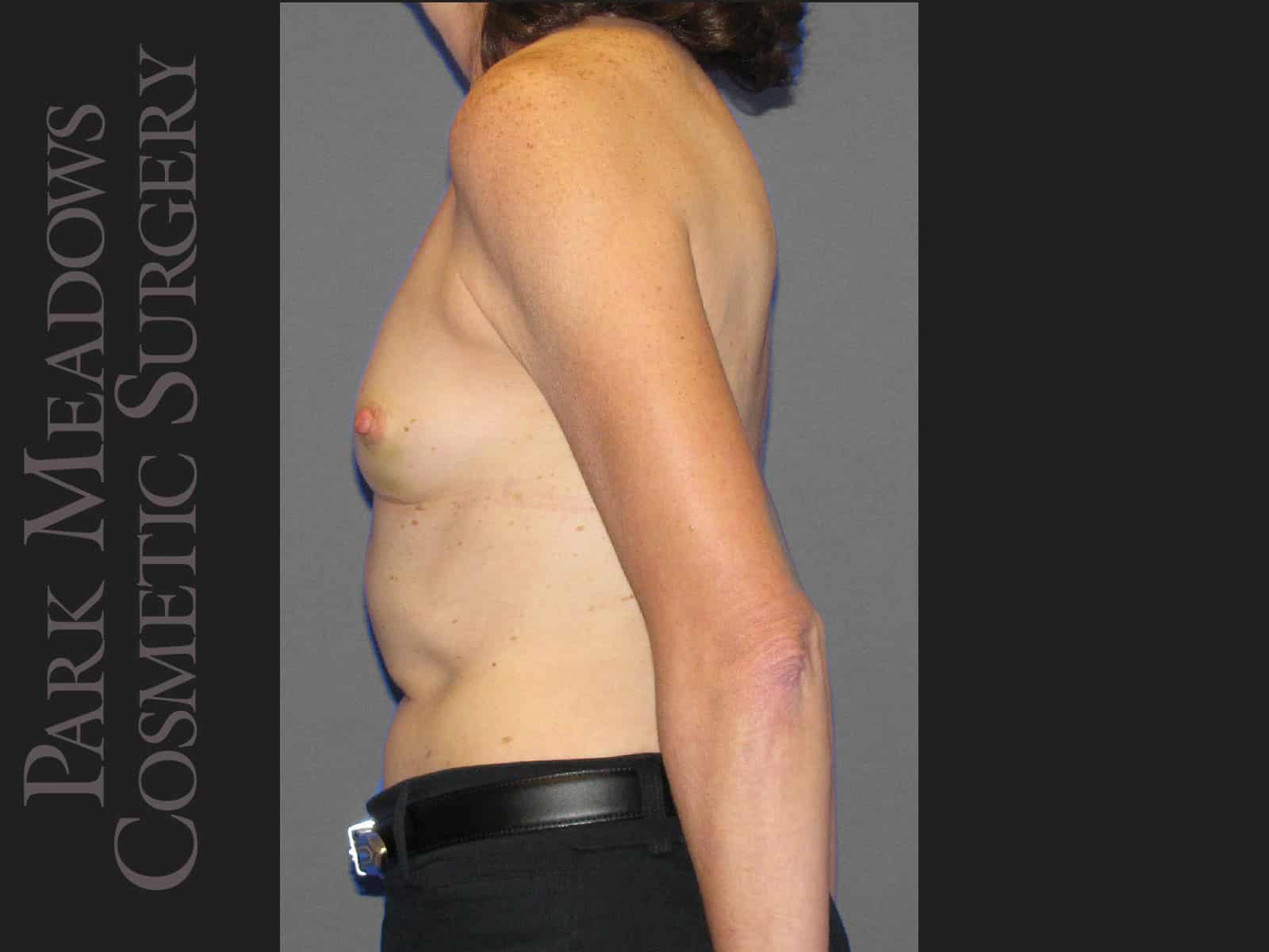 Before Image: Bilateral mastectomy with tissue expanders; silicone implant exchange; nipple reconstruction and areola pigmentation - left-side
