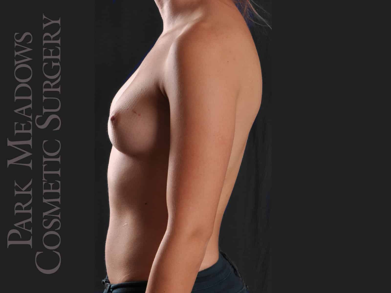 Before Image: Bilateral nipple-sparing mastectomy with direct-to-implant (single stage) breast reconstruction Procedure: Bilateral nipple-sparing mastectomy with direct-to-implant (single stage) breast reconstruction - left-side