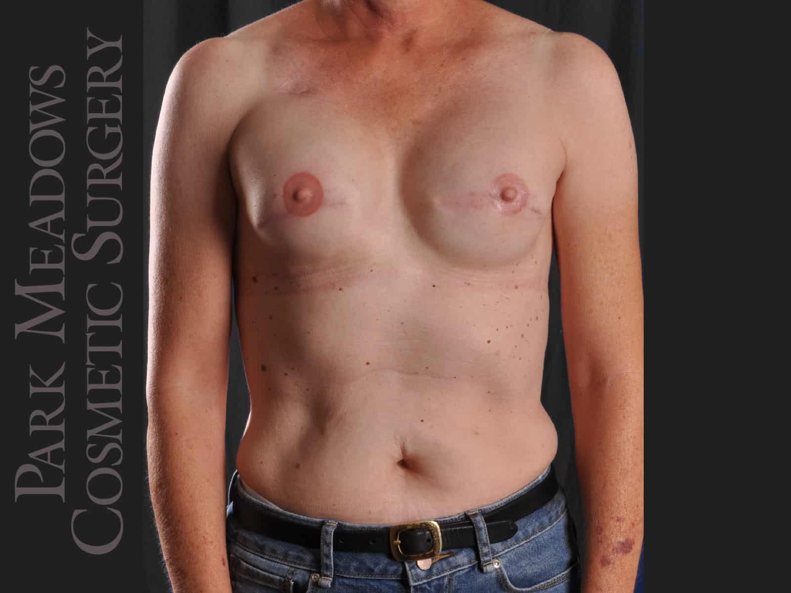 Bilateral mastectomy with tissue expanders; silicone implant exchange; two separate fat grafting sessions; nipple reconstruction and areola pigmentation