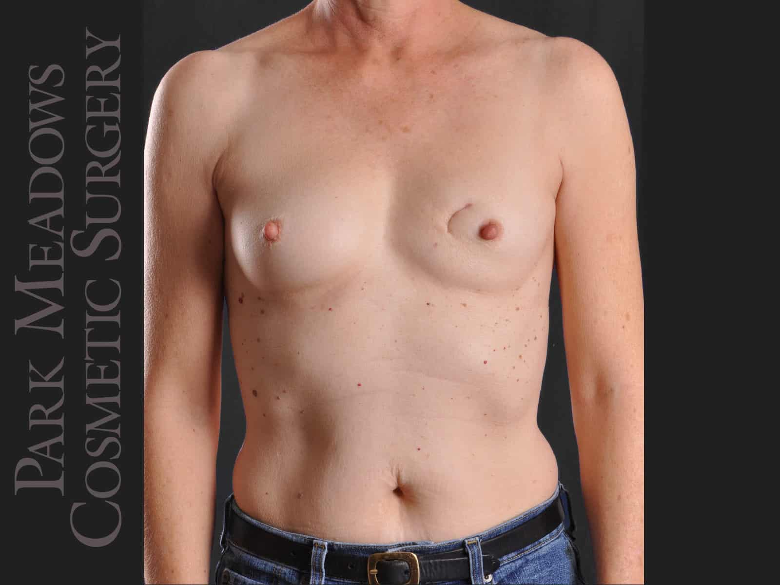 Bilateral mastectomy with tissue expanders; silicone implant exchange; two separate fat grafting sessions; nipple reconstruction and areola pigmentation