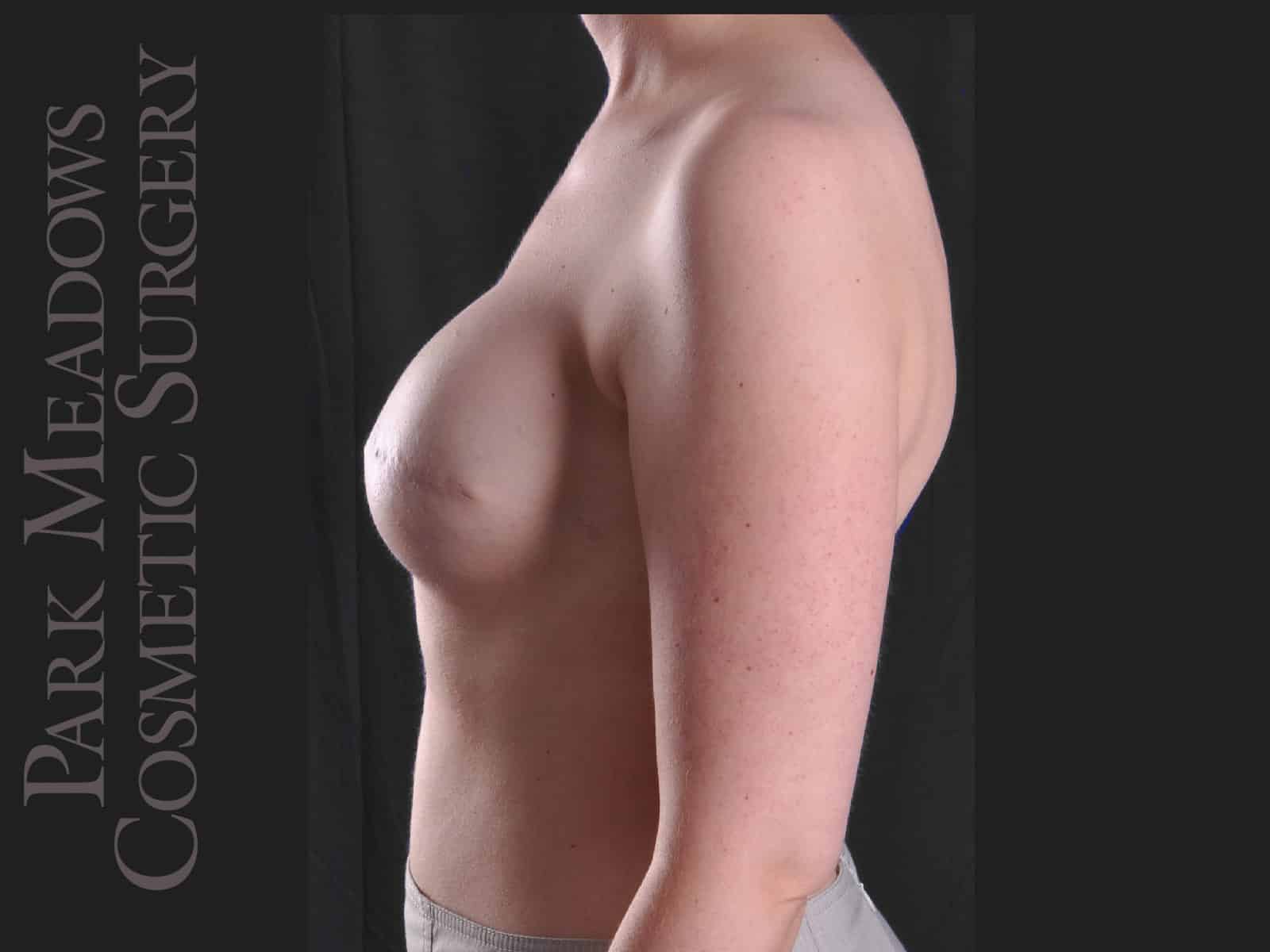 After Image: Bilateral mastectomy with tissue expanders; silicone implant exchange; two separate fat grafting sessions; nipple reconstruction; areola pigmentation - left-side
