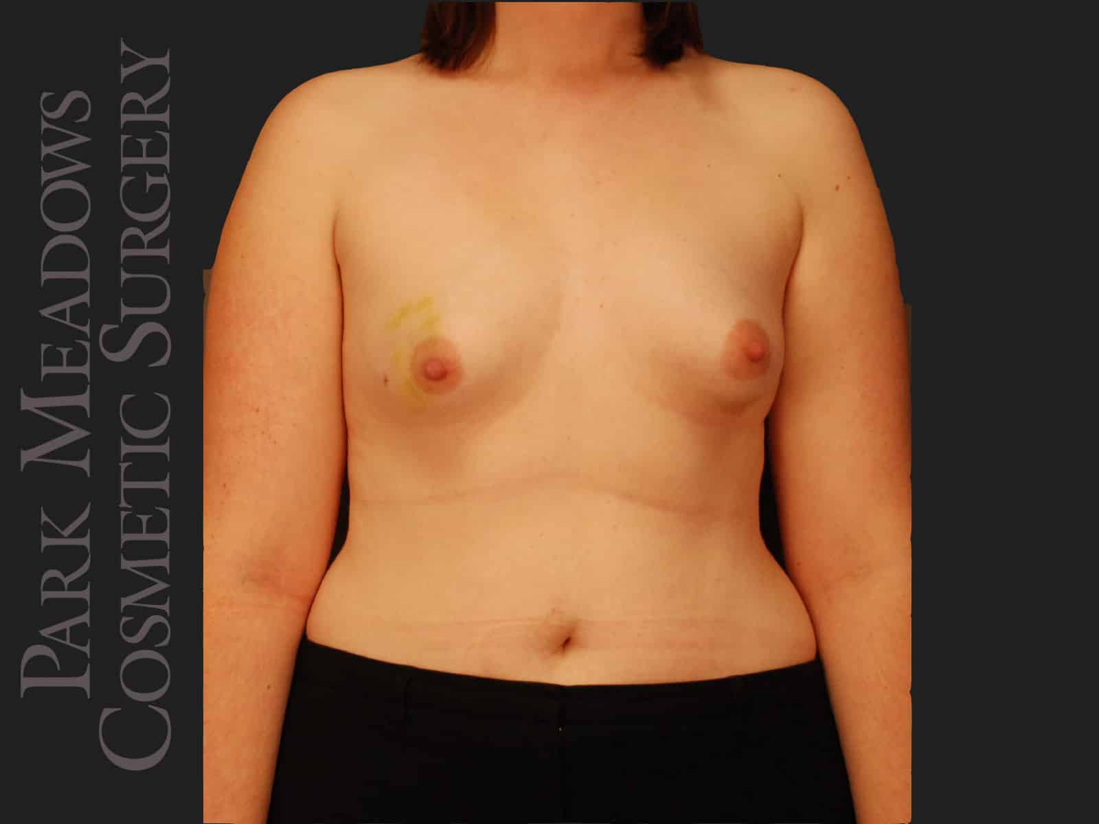 Before Image: Bilateral mastectomy with tissue expanders; silicone implant exchange; two separate fat grafting sessions; nipple reconstruction; areola pigmentation - front