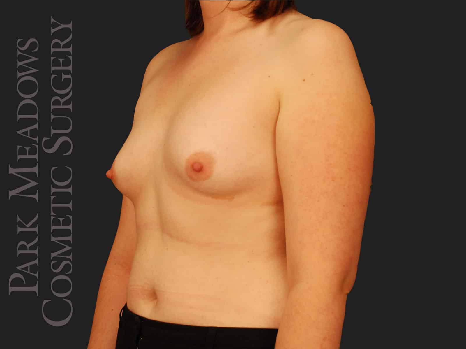 Before Image: Bilateral mastectomy with tissue expanders; silicone implant exchange; two separate fat grafting sessions; nipple reconstruction; areola pigmentation - left-front-oblique