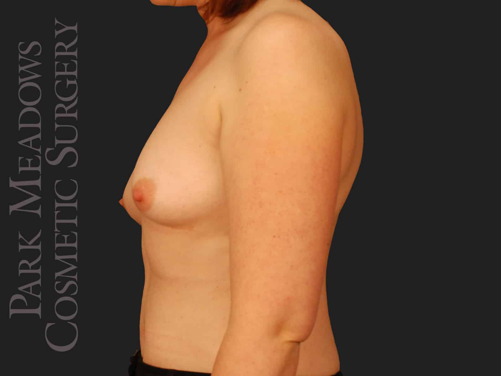 Before Image: Bilateral mastectomy with tissue expanders; silicone implant exchange; two separate fat grafting sessions; nipple reconstruction; areola pigmentation - left-side