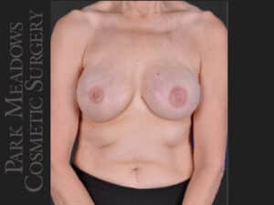 Bilateral mastectomy with tissue expanders; silicone implant exchange; nipple reconstruction and areola pigmentation