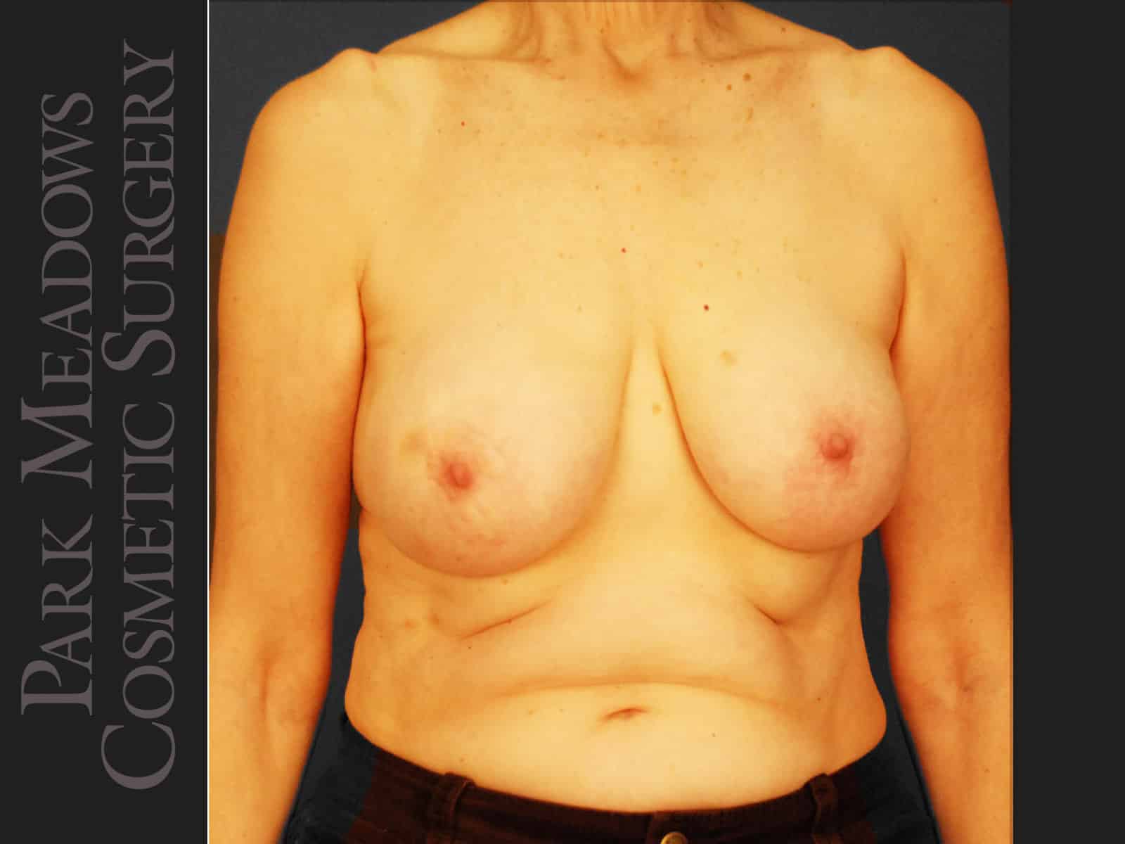 Before Image: Bilateral mastectomy with tissue expanders; silicone implant exchange; nipple reconstruction and areola pigmentation - front