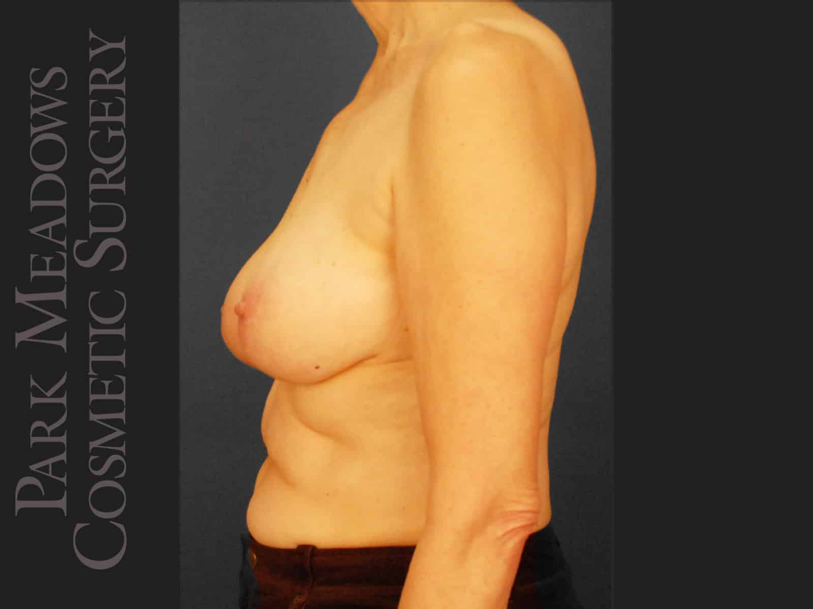 Before Image: Bilateral mastectomy with tissue expanders; silicone implant exchange; nipple reconstruction and areola pigmentation - left-side