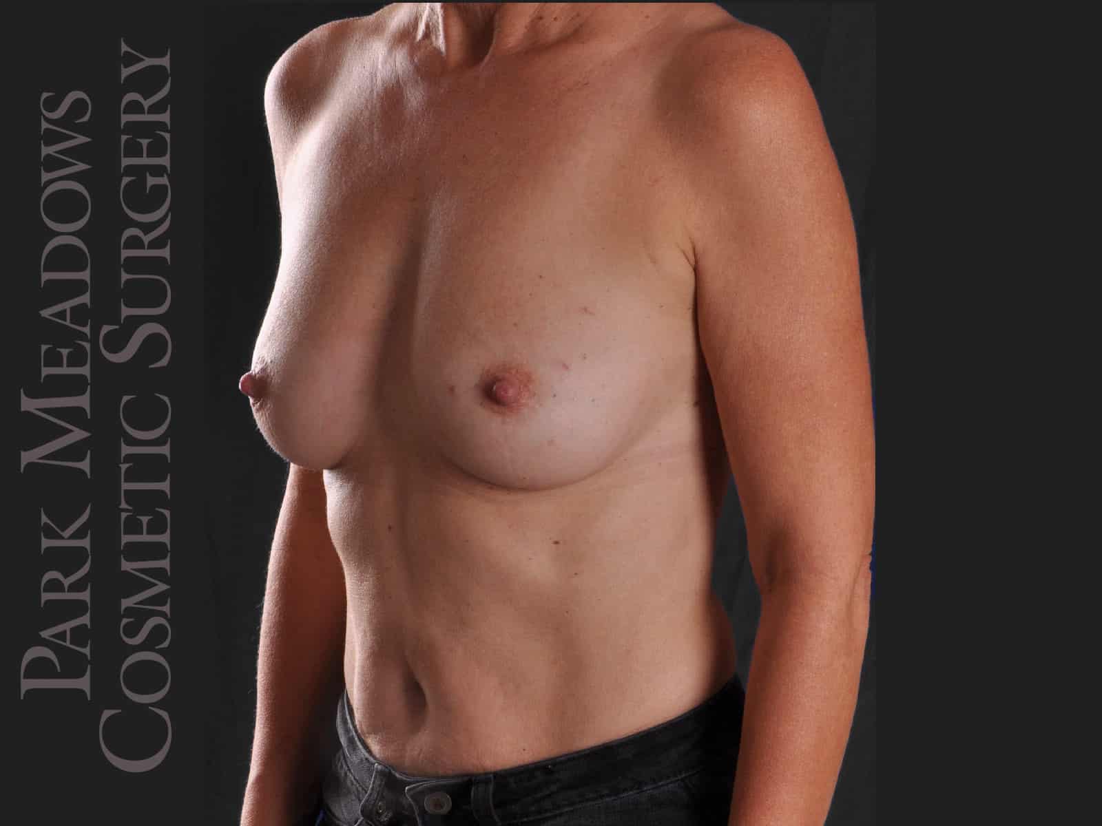 Before Image: Bilateral nipple-sparing mastectomy with direct-to-implant breast reconstruction - left-front-oblique