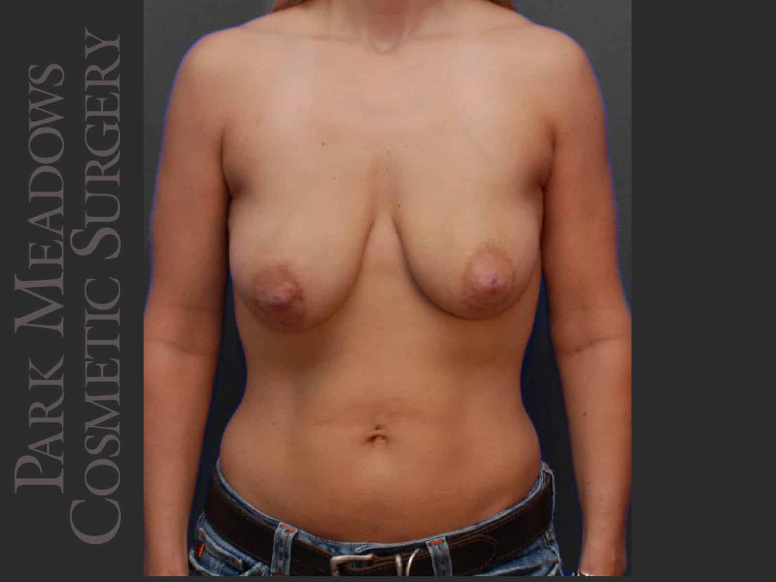 Bilateral mastectomy with tissue expanders; silicone implant exchange; one fat grafting session with nipple reconstruction; areola pigmentation